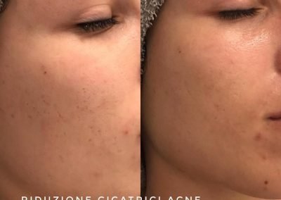 Riduzione Cicatrici Acne Centro estetico Esthetic Lab Barbisano